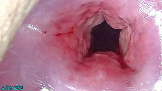 Uncensored Japanese Cervix Distension and Uterus Dilation respecting Penetration