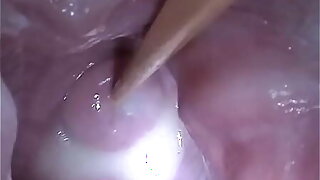 Insertion Semen Cum in Cervix Wide Dilatation Pussy Speculum